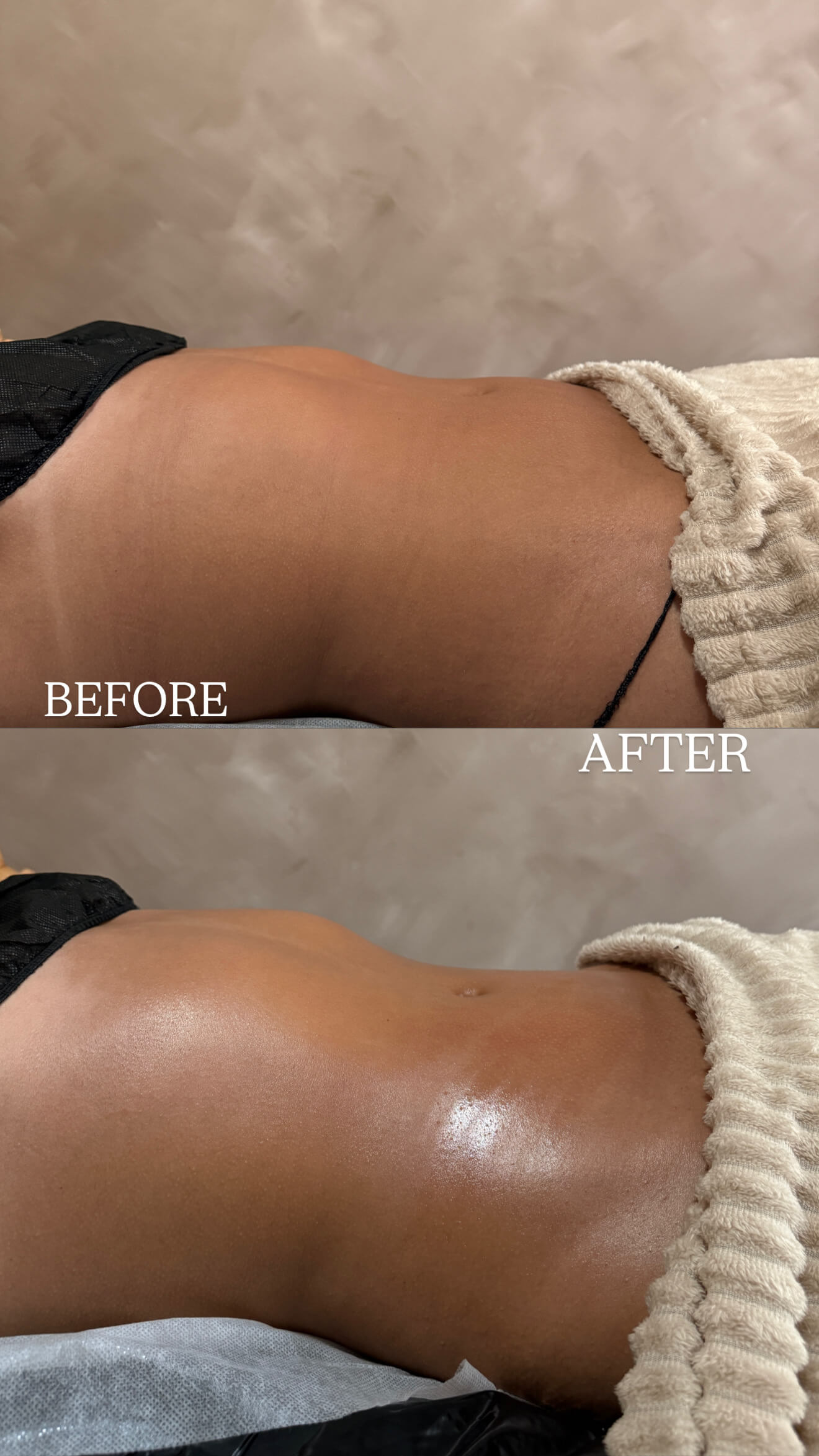 Lymphatic drainage result